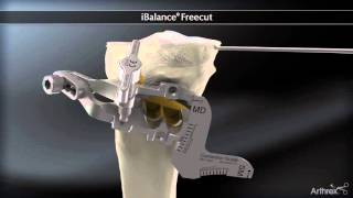 Chirurgie de lArthrose Osteotomie tibiale de valgisation Dr Philippe Loriaut [upl. by Clift]