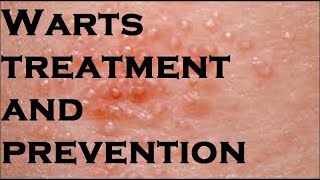 Warts treatment and prevention [upl. by Ledba]