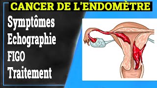 Cancer de lEndomètre Symptômes Causes Traitement  Gynécologie [upl. by Ovid]