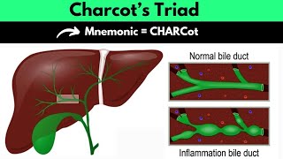 Charcot’s Triad Mnemonic  Charcot’s Triad For Ascending Cholangitis Mnemonic  Dr Mubashar Ata [upl. by Rebba521]