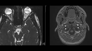 case 22 diplopia and squint [upl. by Naloj]