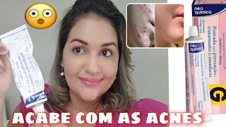 Pomada Nistatina com óxido de zinco para acabar com ACNES e MANCHAS  respondendo inscritos [upl. by Anicart]