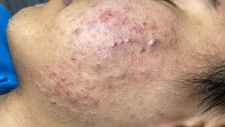 ACNE TREATMENT VU QUYNH MI Acne On Teens Cheek 2024 [upl. by Mayce692]