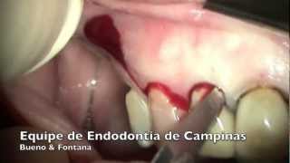 Incisão para Cirurgia Paraendodôntica  Equipe de Endodontia de Campinas [upl. by Oidiple]