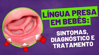 Língua Presa em Bebês Sintomas Diagnóstico e Tratamento [upl. by Nahbois]