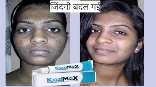 Kozimax Skin Lightening Cream  Uses Side effectsReviews Composition In Hindi [upl. by Celina504]