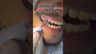 عملية تنضيف الاسنان ضروري جدا جدا  اغرب حالة😳😳🚨 dentalcare scaling تنضيفالاسنان [upl. by Eiznikcm402]