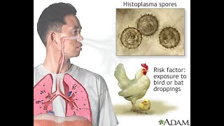 Diagnosis and Treatment of Histoplasmosis [upl. by Eerual95]