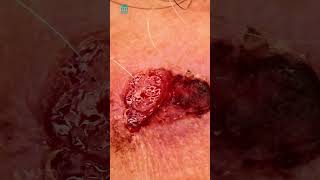 What is squamous cell carcinoma  Shorts [upl. by Acissev]