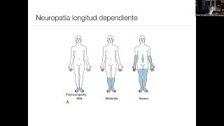 Neuropatías periféricas [upl. by Ydieh87]