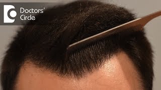 How many hair transplant grafts do you need to cover bald areas  Dr Deepak P Devakar [upl. by Drazze102]