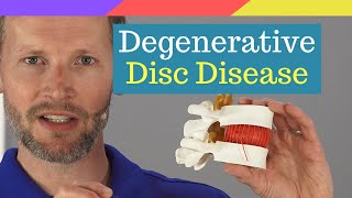 Explained Degenerative Disc Disease [upl. by Amled]