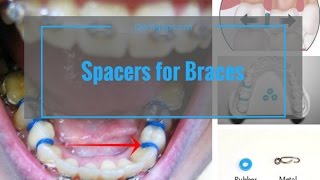 Spacer For Braces  Do They Hurt  Check Live View [upl. by Ade]