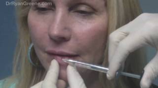 Lip Augmentation with Juvederm Injection  Fort Lauderdale [upl. by Kohsa487]