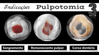 Quando indicar a Pulpotomia  Três pontos chaves a serem observados  HELDER FERNANDES [upl. by Eentruok377]