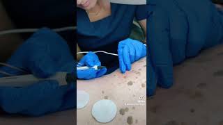 Seborrheic Keratosis removal [upl. by Jodie]