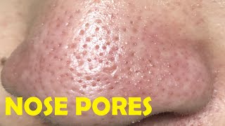 how to get rid of pores on nose instantly [upl. by Ludba]