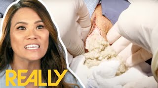 Dr Lees MOST INTENSE Cyst Removal Surgeries  Dr Pimple Popper [upl. by Anneres989]