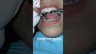 Fixed braces removal dentist orthodontics dentalbraces tooth islamabad rawalpindi [upl. by Aehsrop]