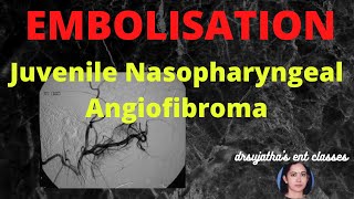 163Juvenile Nasopharyngeal Angiofibroma Part 6 Nonsurgical Treatments Embolisation of JNA jna [upl. by Ymereg90]