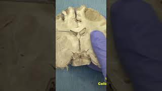 Tuberal area of hypothalamus interventricular foramenanatomy neuroanatomy hypothalamus brain [upl. by Marisa]