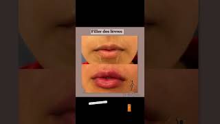 Filler lips 0530550870 kenitra morocco 0628862910 rabat filler 0628862910 casablanca [upl. by Isoj250]