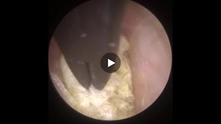 754  Cotton Wool Ball Ear Wax Removal [upl. by Collete]