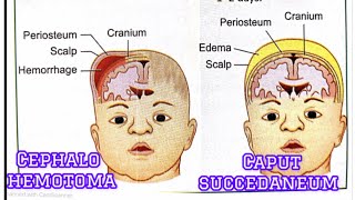 Difference between cephalohematoma and caput succedaneum cephalohemotoma caputsuccedaneum hindi [upl. by Kelcey]