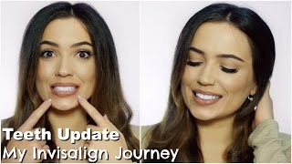 Invisalign Update Journey  More Refinements [upl. by Madelaine445]