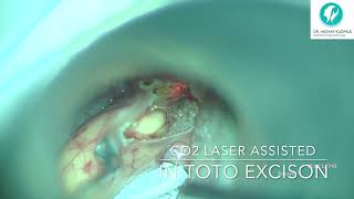 Valecullar cyst  Transoral laser surgery assisted excision [upl. by Patrizio]