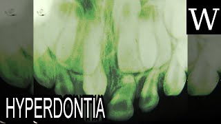 HYPERDONTIA  WikiVidi Documentary [upl. by Enieledam]