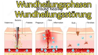 Wundheilungsphasen und wundheilungsstörung im Überblick [upl. by Anelahs]