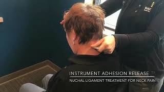 Nuchal Ligament treatment for neck pain [upl. by Aikan]