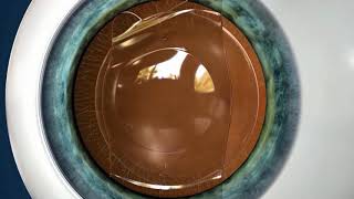 Vision Correction for High Levels of Myopia amp Astigmatism [upl. by Drewett736]