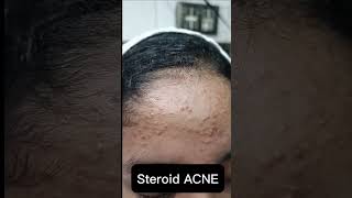 Steroid Acne l Common Causes of Acne [upl. by Raffaello762]