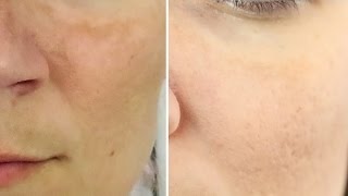 8 Natural Home Remedies to Clear Melasma [upl. by Ettore]