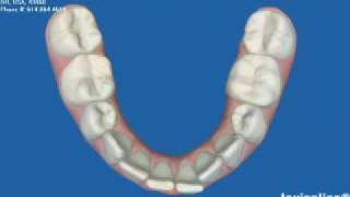 Invisalign Express OrthodonticsBefore amp AfterMick Family Dental [upl. by Idas654]