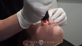 Erbium Laser Resurfacing  Treatment of Melasma  Sun Spots and Pigmentation  Beverly Hills CA [upl. by Regor]