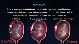 UOG video abstract Outcome of twin pregnancy with two live fetuses at 11–13 weeks’ gestation [upl. by Mcmaster899]