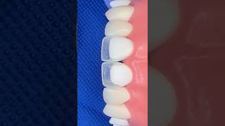 Composite layering palatal shell proximal box smiledesign dental [upl. by Aehcim199]