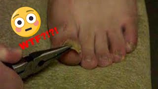 TheToe  Ingrown toenail being ripped off by pliers [upl. by Aerol]