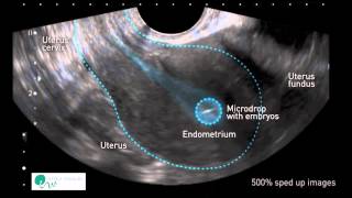 INSTITUT MARQUÈS  I movimenti dellutero favoriscono limpianto dellembrione [upl. by Orimlede35]