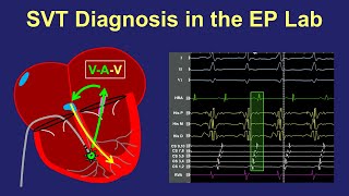 EIF or echogenic intracardiac focus Ultrasound video [upl. by Cooperstein208]