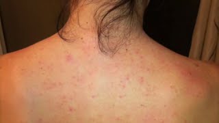 Dayna’s Story Improvement with Folliculitis or “Back Acne” [upl. by Veronica]