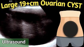 Ultrasound 19 cm Large Ovarian Cyst  equal to size of Handball in Abdomen [upl. by Bornie]