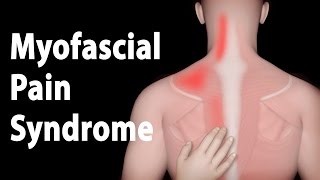 Myofascial Pain Syndrome and Trigger Points Treatments Animation [upl. by Nayarb]