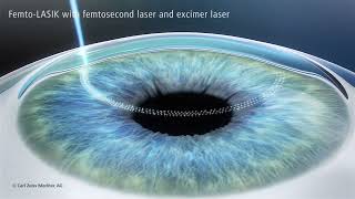 LASIK Laser Eye Surgery explained [upl. by Nekcarb]