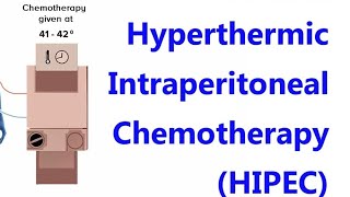 HYPERTHERMIC INTRAPERITONEAL CHEMOTHERAPY HIPEC For Mrcog part3 CaseDiscussionsMRCOGDrShabana [upl. by Heger]