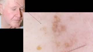 Desmoplastic melanoma a difficult diagnosis to make by Dr A Marghoob [upl. by Sashenka]