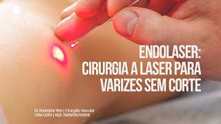 Endolaser Cirurgia a laser para Varizes SEM corte [upl. by Haze735]